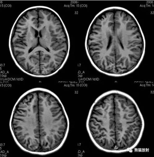双侧额叶脑白质高信号图片