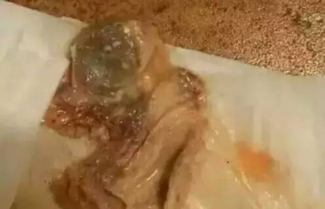 太牛了花了258元让她子宫洗了个澡还排出了这些