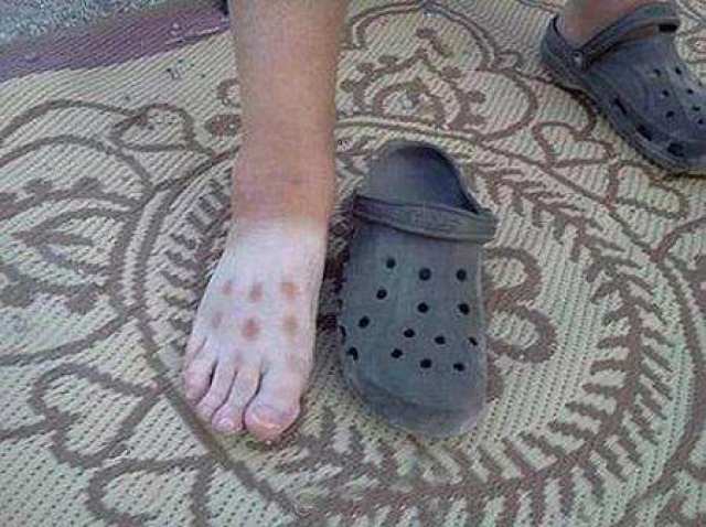 搞笑糗事: 夏天洞洞鞋穿多了就会变成这样