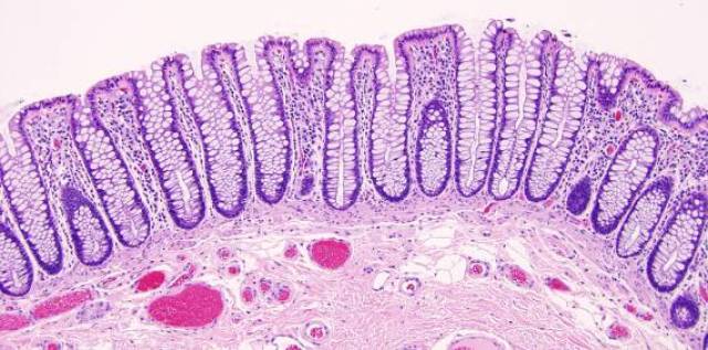 colitis