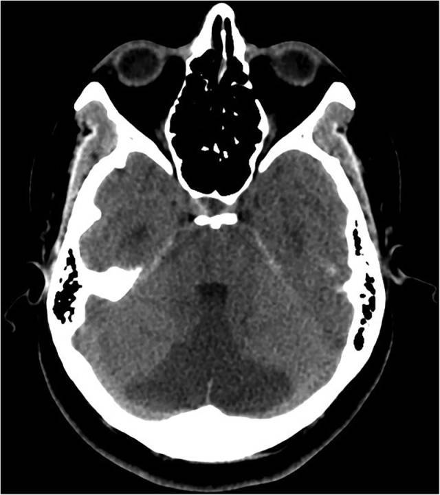小脑半球ct图片图片