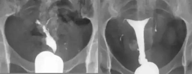 输卵管造影有多重要?这些你都知道吗?