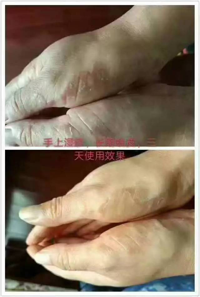 皮肤问题,面积大于全身皮肤3%以上,严重者甚至多年治不好的皮肤问题