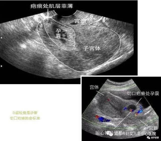 科普| 二胎風暴 瘢痕子宮怎麼辦?