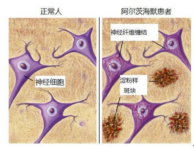 德國的阿爾茨海默教授提出了一種以記憶力下降為主要症狀的腦部疾病