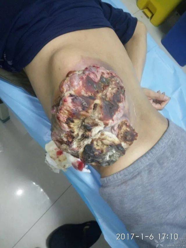 病例讨论:左侧腹膜后肿瘤,如何治疗?