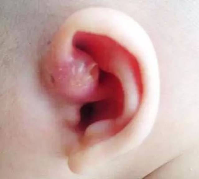 单纯型 耳前瘘管,则表示 终生不 会 发生感染,可不必手术