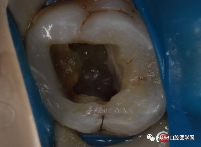 后牙邻面龋,邻面龋,邻面龋齿(第12页)_大山谷图库