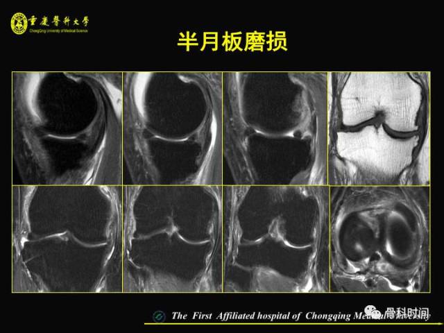 半月板损伤的核磁表现图片