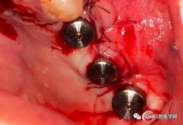 同种异体骨块状骨移植案例