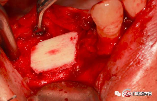 同种异体骨块状骨移植案例