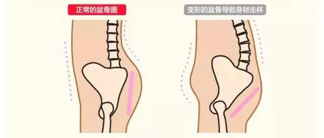 盆骨鬆弛引發女性疾病