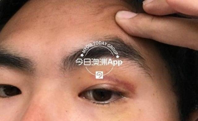 小阳向记者展示了自己受伤一周后拍摄的照片,照片中他的 左眼皮上有