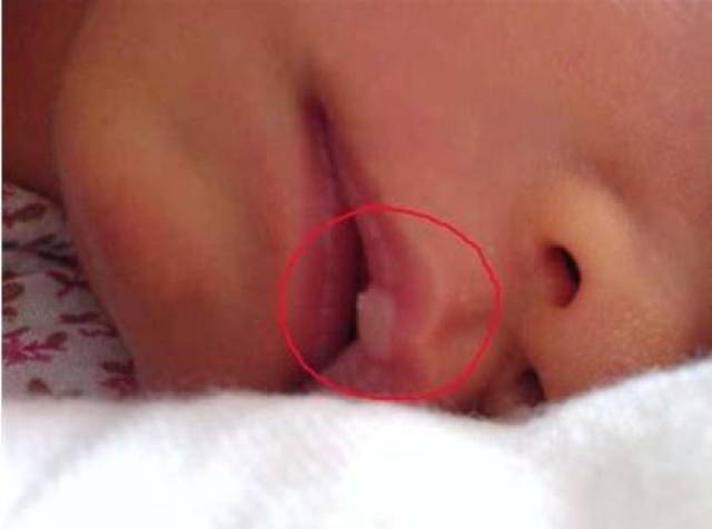 新生宝宝口唇出现的白色小泡是因为吸吮引起的,与干燥缺水没有关系