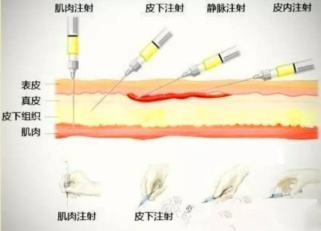 静脉注射深度图片