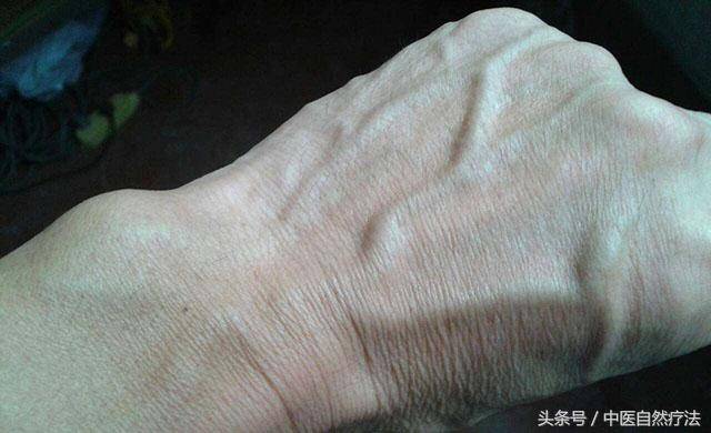 头部青筋