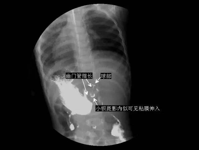 食管癌龛影图片图片