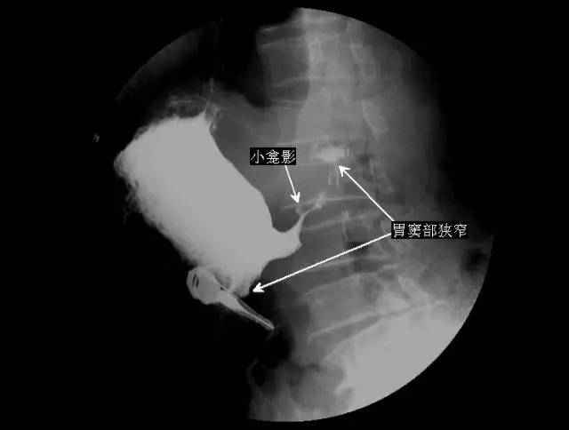 5 分钟读懂消化道造影片(胃篇)