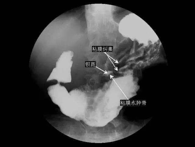 胃癌半月综合征图片