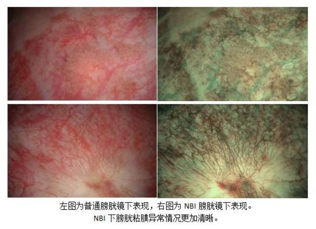 【医疗动态】医大二院泌尿外科窄带光软性膀胱镜造福膀胱肿瘤患者