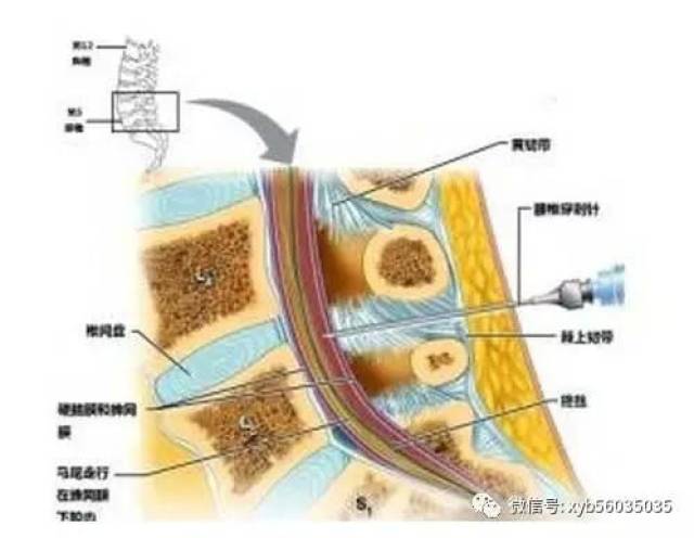 最全的骨髓穿刺过程讲解,带你亲历骨穿