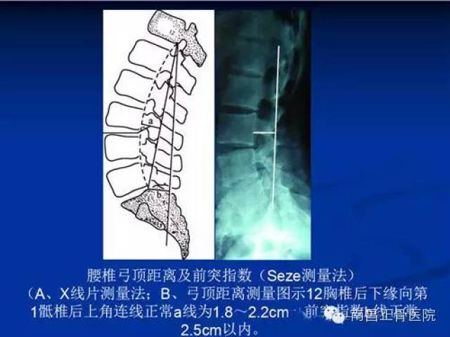 6,腰骶角的测量