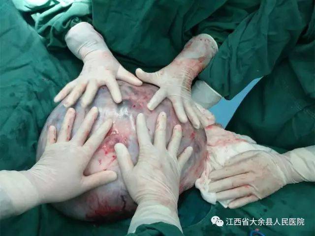 医生顺利将子宫实性肿物取出,重约8斤,大小约227mm×146mm×306mm包块