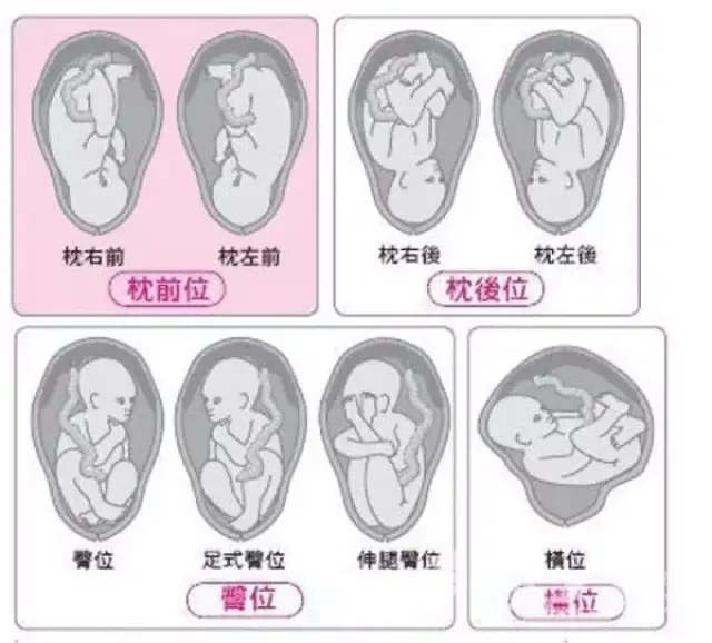 临近宫口开全，居然还能扭转胎位不正，实现顺产！这波操作666_搜狐网