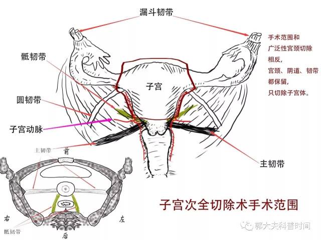 楔形切除 图解图片