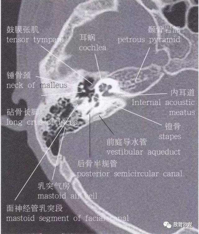 颞骨岩部断层解剖图图片