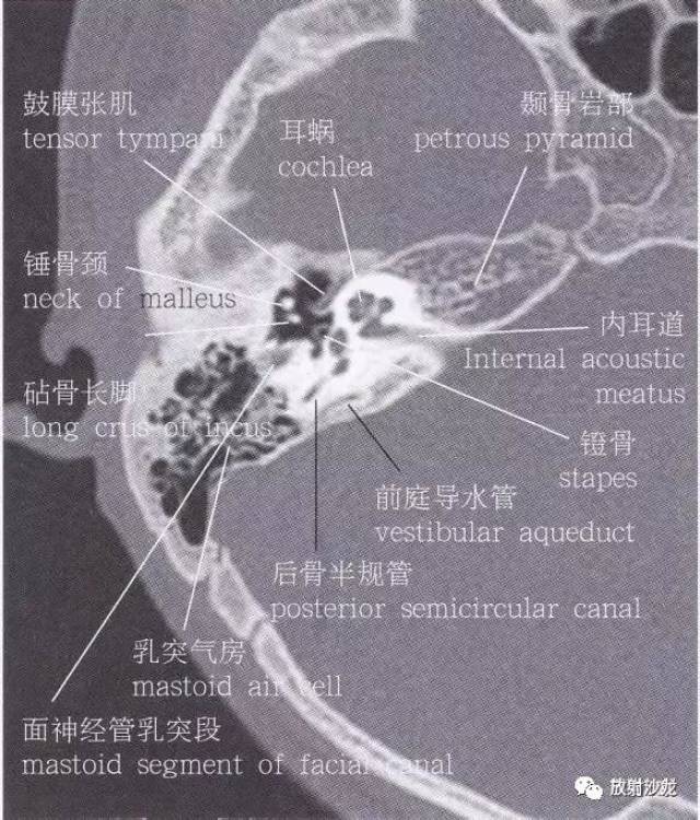 【解剖】颞骨大体解剖 轴位及冠状位ct断层图像