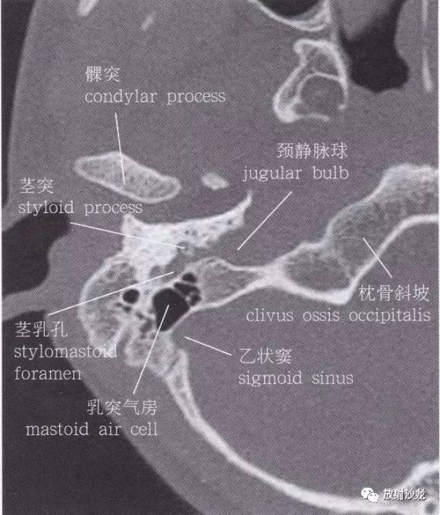 岩骨ct解剖图图片