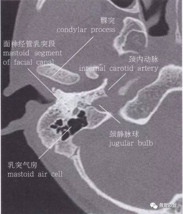 舌下腺ct解剖图图片