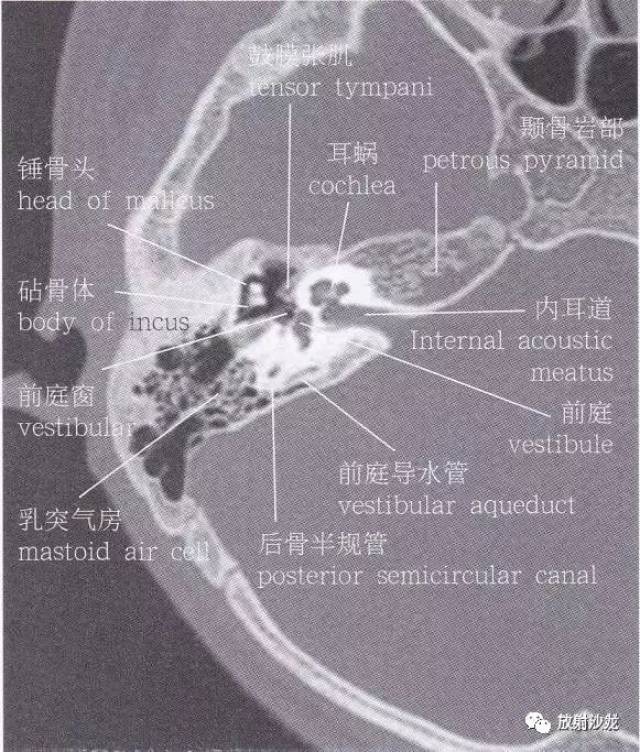 岩骨ct解剖图图片