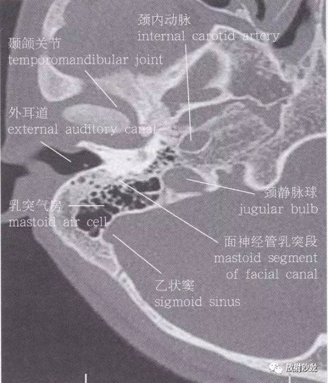 颞骨岩部ct解剖图图片