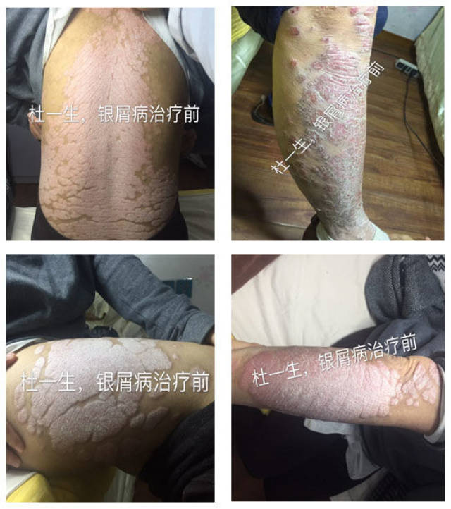 银屑病俗称牛皮癣,中医称为干癣,风癣.
