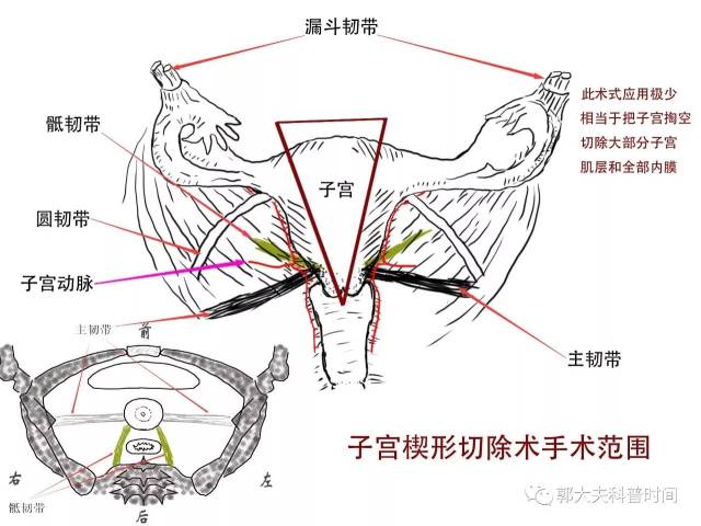 子宫切除医保2019年2月3日在三甲医院做子宫切除手术