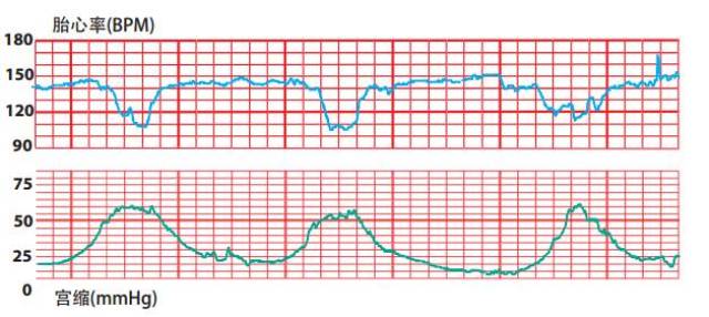 四,胎心率正弦波型