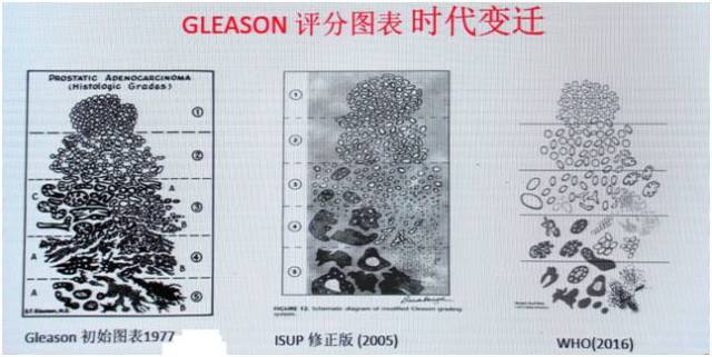 前列腺癌ajcc分期和gleason评分更新点解读