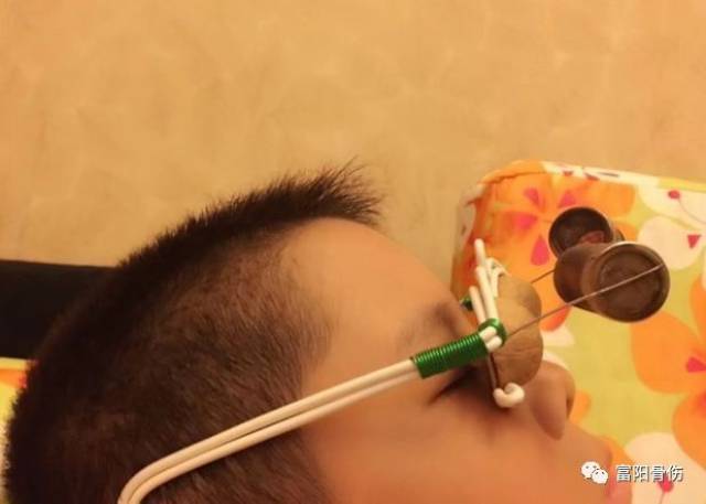 让视界更美丽——我院中医护理门诊推出"核桃灸"咯!