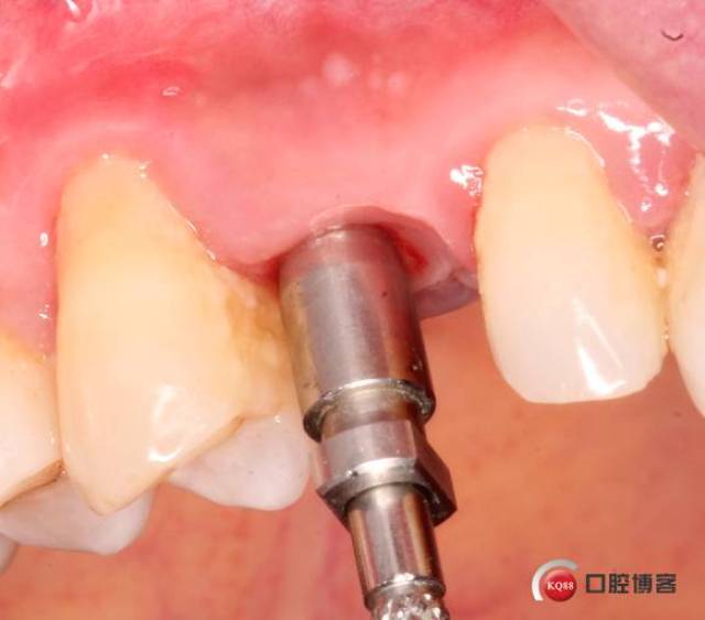 光固化树脂制作个性化转移杆.
