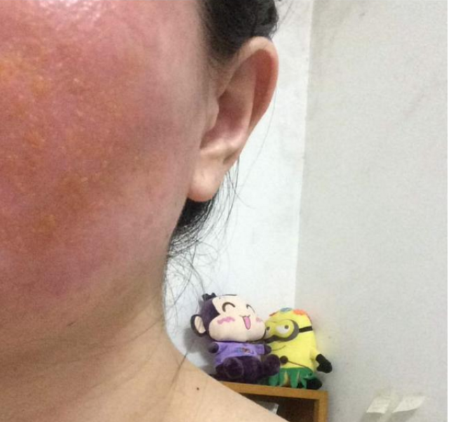 到底怎么有效修复激素脸?