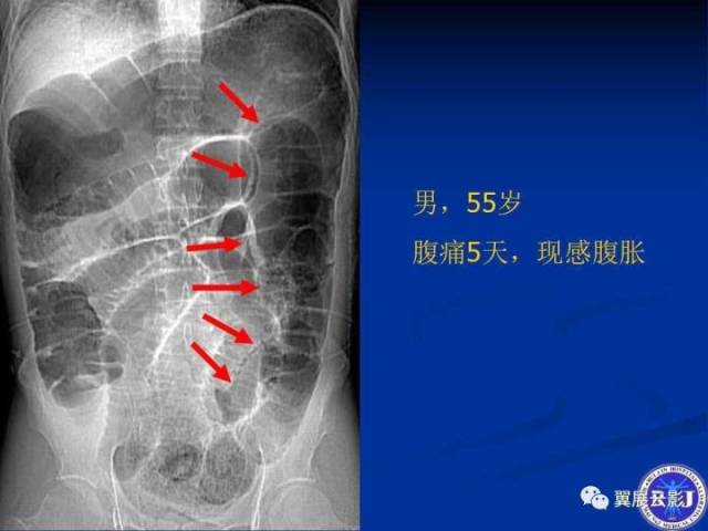 空肠梗阻图片