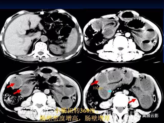 急性绞窄性肠梗阻ct诊断