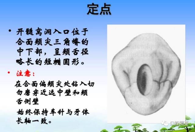 详解:各牙位的开髓【整理版】