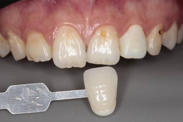 牙贴面:一次性解决多种牙齿问题,安装过程告诉