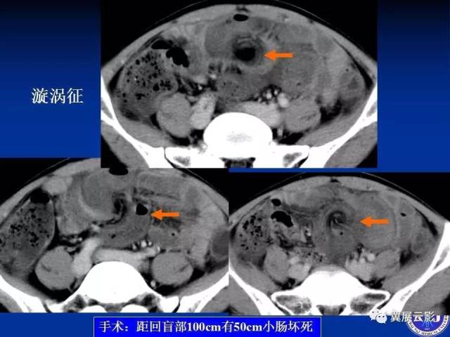 急性絞窄性腸梗阻ct診斷