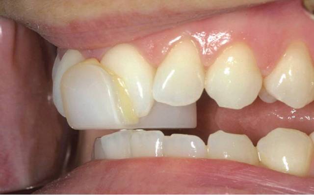 【功能修复】合垫治疗的临床指南