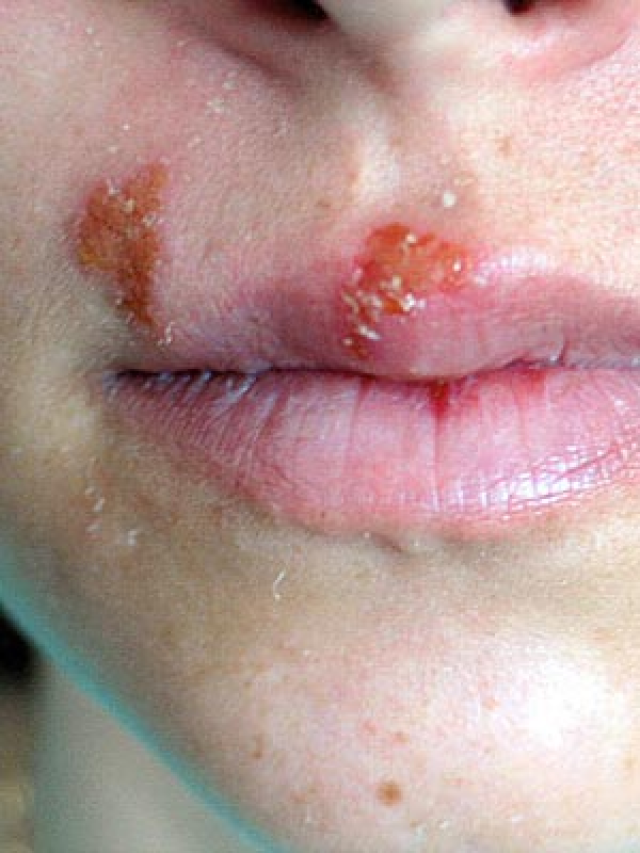 2/11口腔疱疹:嘴吧周围起水泡生殖器疱疹的症状包括溃疡,生殖器或臀部