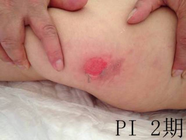 2018护士资格考试考点真题每日一练||干货丨失禁性皮炎与1,2期压疮